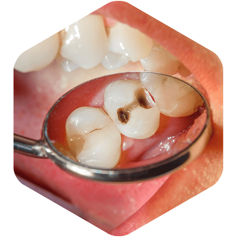 Examination of molars and cavities are found in them